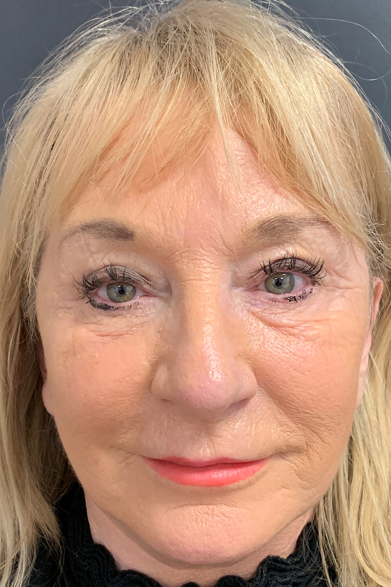 View 1 — after (post-operative)
